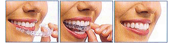 Invisalign